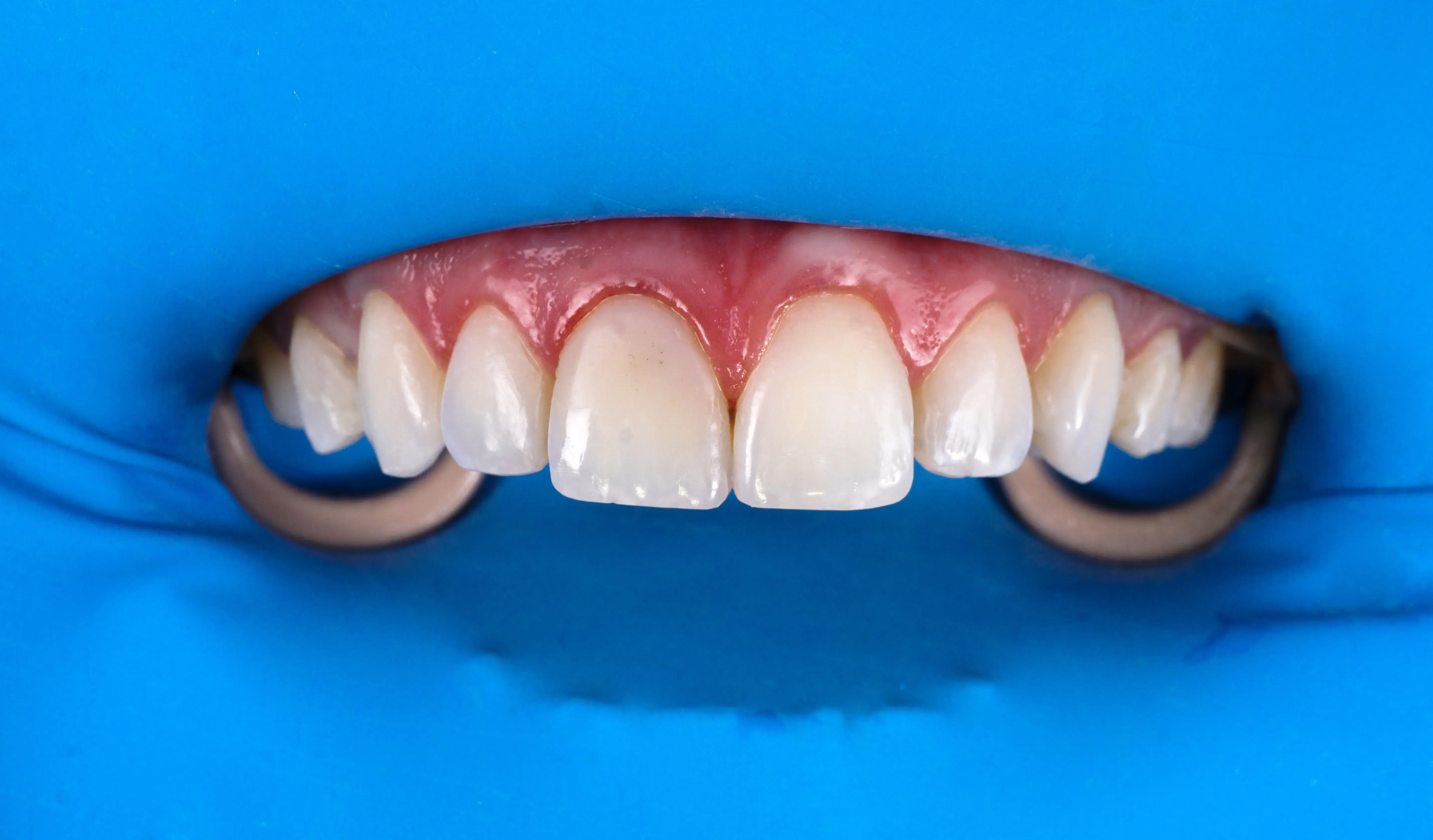 Aislamiento dental 3